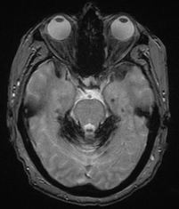 superficial siderosis MRI