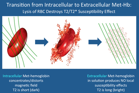 Transition from intracellular to extracellular methemoglobin