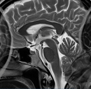 phase wrap-around artifact MRI