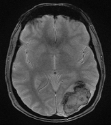 Spoiled gradient echo (GRE) MRI