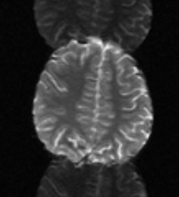Nyquist N/2 Ghost artifact MRI