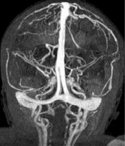 slow flow v thrombosis MRI