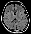 T2-FLAIR Brain image