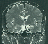T2 brain map