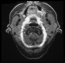 phase wrap-around artifact on 3DFT MRI