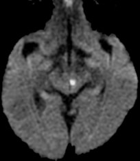 central point artifact MRI