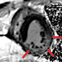cardiac sarcoidosis MRI
