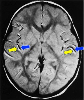 Spatial misregistration of flow MRI