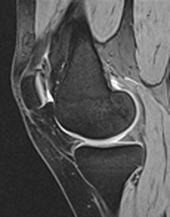 Dual-echo steady state (DESS) image knee