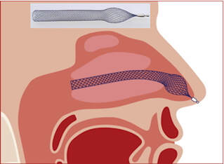 Alaxo nasal stent
